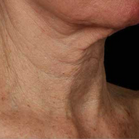 Woman's Neck Before Using Anti Aging Neck Skincare Cream Product