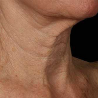 Woman's Neck After Using Anti Aging Neck Skincare Cream Product