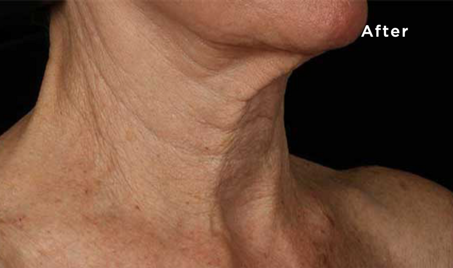 Woman's Neck After Using Anti Aging Neck Skincare Cream Product