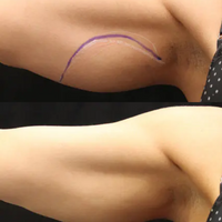 SKIN TIGHTENING PACKAGE