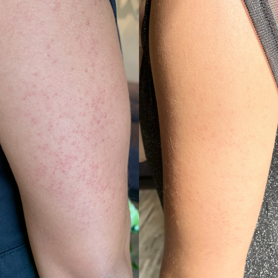 Arm Before and After Using Acne Treatment Kit