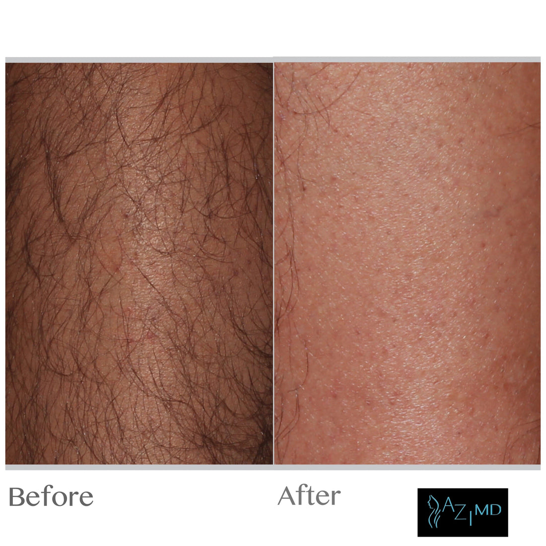 BOGO LASER HAIR REMOVAL PACKAGE